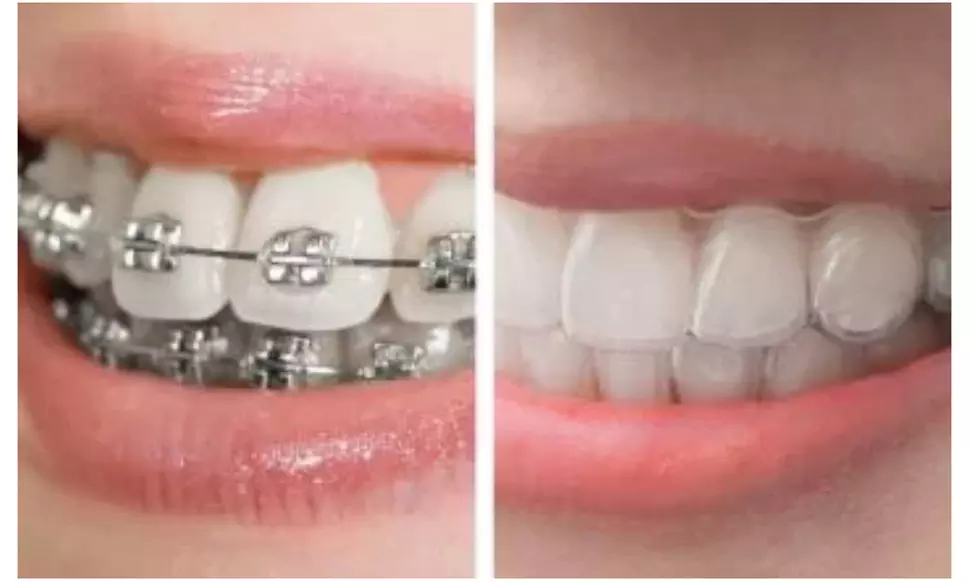 Clear Aligners Or Invisalign With Dental Exam, X-Ray And Cleaning