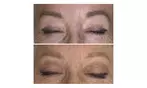 Three Tattoo Removal Sessions on an Area Up to 2x2, 3x3 or 4x4 Inches