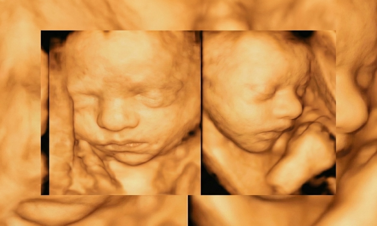 Ecografía 4D HD Live con fotos, vídeo y canastilla de bebé