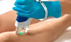 Six Laser Hair-Removal Sessions on a Medium, Large or Extra Large Area