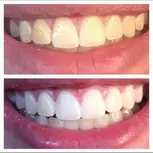 One Three 50 Min In-Office Teeth-Whitening Treatment at BodyCocktail