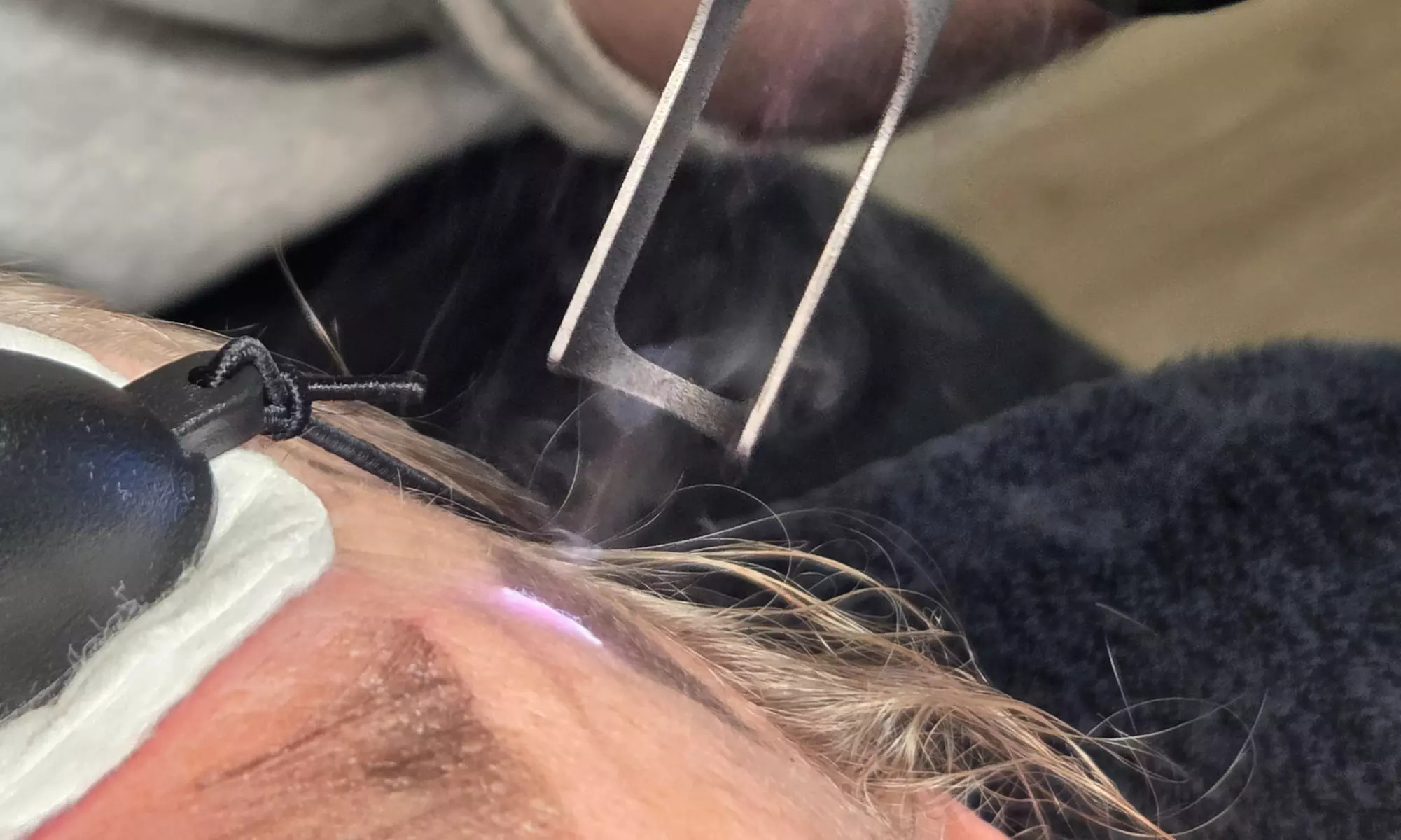 Effectieve carbon laser peeling voor huidverjonging en collageenboost
