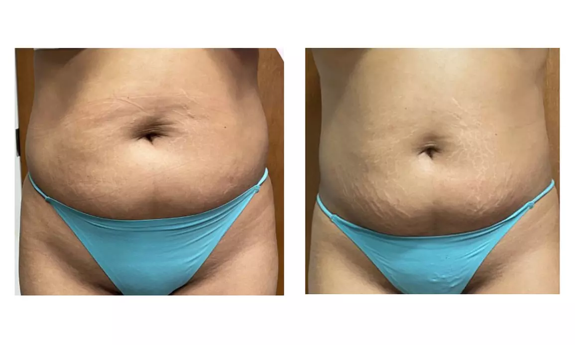 30 or 60-Min Brazilian Lymphatic, Body Wrap, Wood Therapy, & More