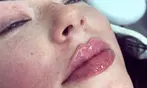 1ml Lips or 2ml choice of area of Premium Dermal Filler