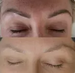 Eyebrow Tattoo Removal: Save Up to 30% Off at MB Advanced Beauty MED!