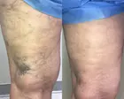 Discover Non-Invasive Spider Vein Consultation and Treatment