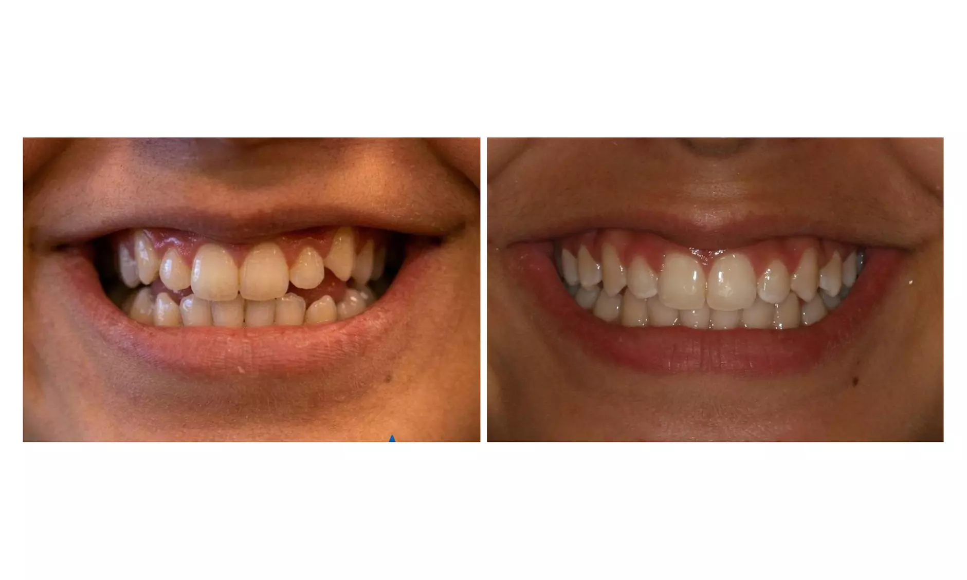 Clear Aligner Orthodontic Treatment