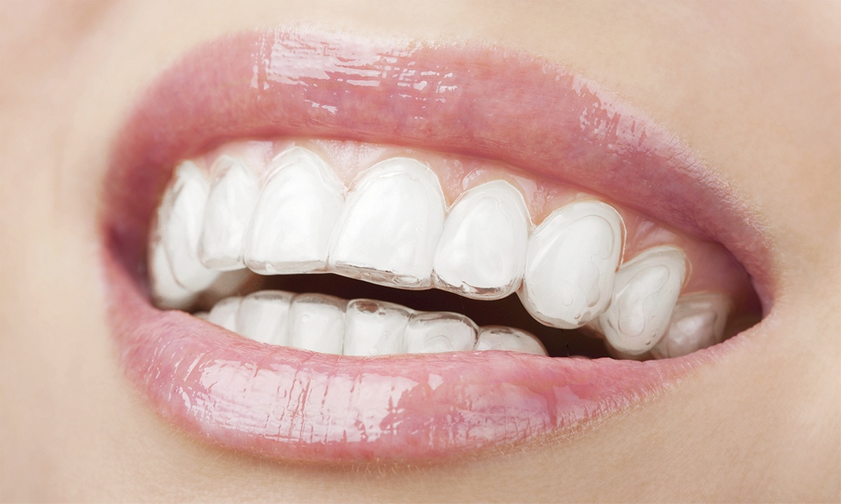 Explore Invisalign Consultation with Comprehensive Care