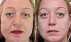 Recente HIFU 22D 2026 Facelift Zonder Snijden en gezichtsbehandeling
