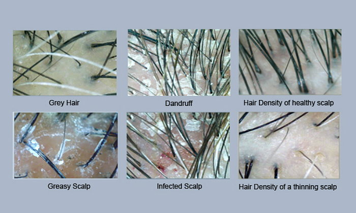 infected hair follicles on head #10