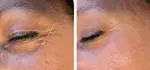 Microneedling of Korean Collagen Booster in Amsterdam