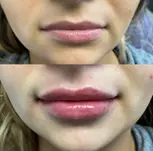 Smooth and Refreshed Look: Botox Injectable (20, 40 or 60 Units)