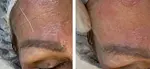 Microneedling of Korean Collagen Booster in Amsterdam