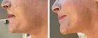 Microneedling of Korean Collagen Booster in Amsterdam