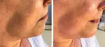 Microneedling of Korean Collagen Booster in Amsterdam