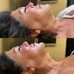 Microneedling of Korean Collagen Booster in Amsterdam