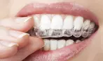 Invisalign Treatment Credit for Straighter Smile with Consultation