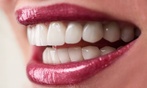 Zoom Whitening: Choose 30 or 60 Minutes, Single or 3-Pack