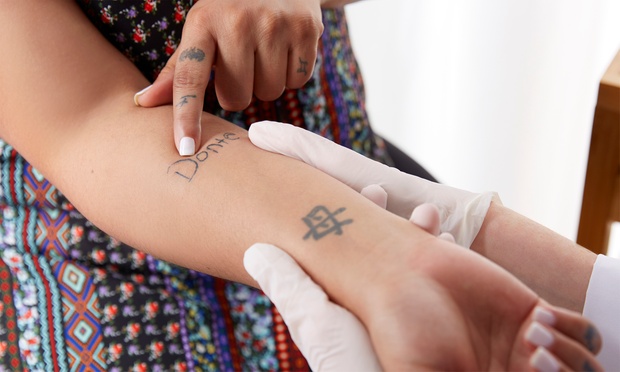 Tattoo removal