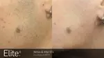 Say Goodbye to Unwanted Hair with Six Laser Hair-Removal Sessions