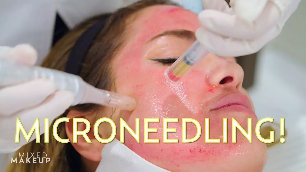 Up to 50% Off on Micro-Needling at PBS Spa