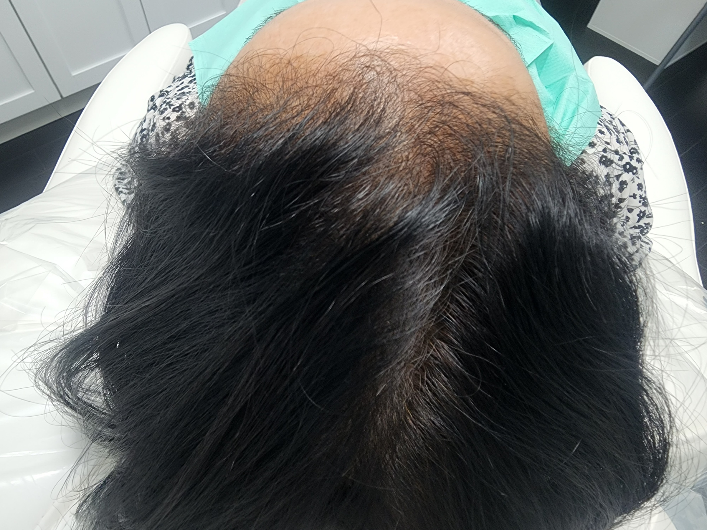Boost Hair Growth with PRP Hair Restoration Treatments