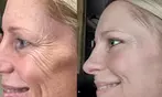 Plasma Fibroblast Eye, Jowl & Neck Lift Treatment