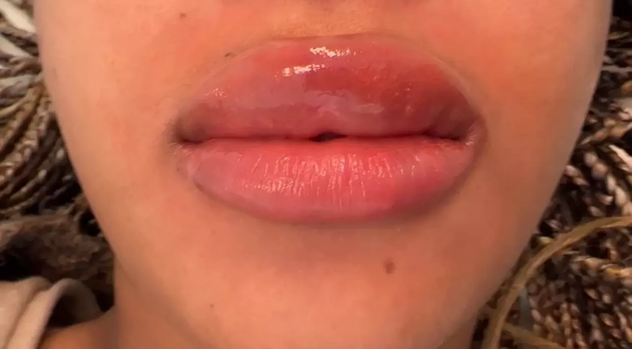 Enhance Natural Beauty with Lip Neutralization Treatment