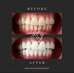 Up to 40% Off on Teeth Whitening at Seattle Teeth Whitening