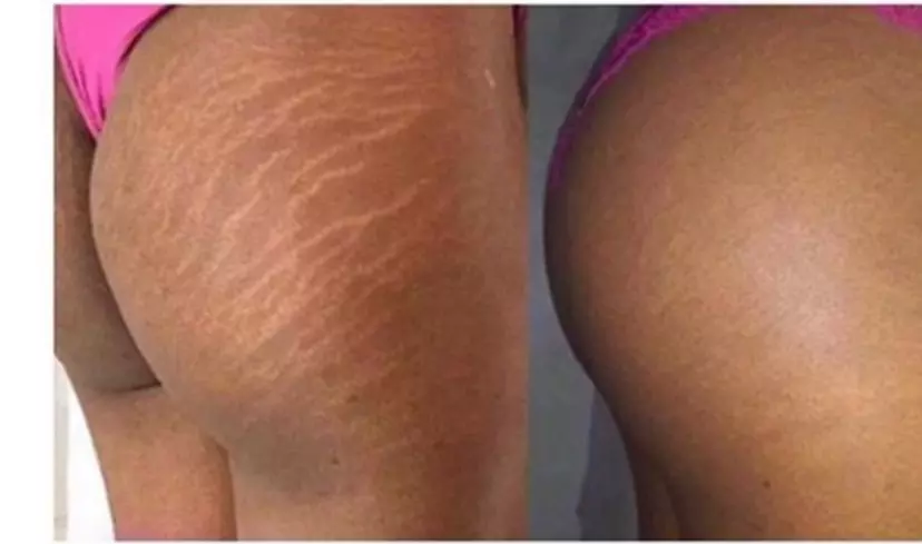 Areola Tattoo Treatment, Scalp Micropigmentation Or Cheek Blush Tattoo