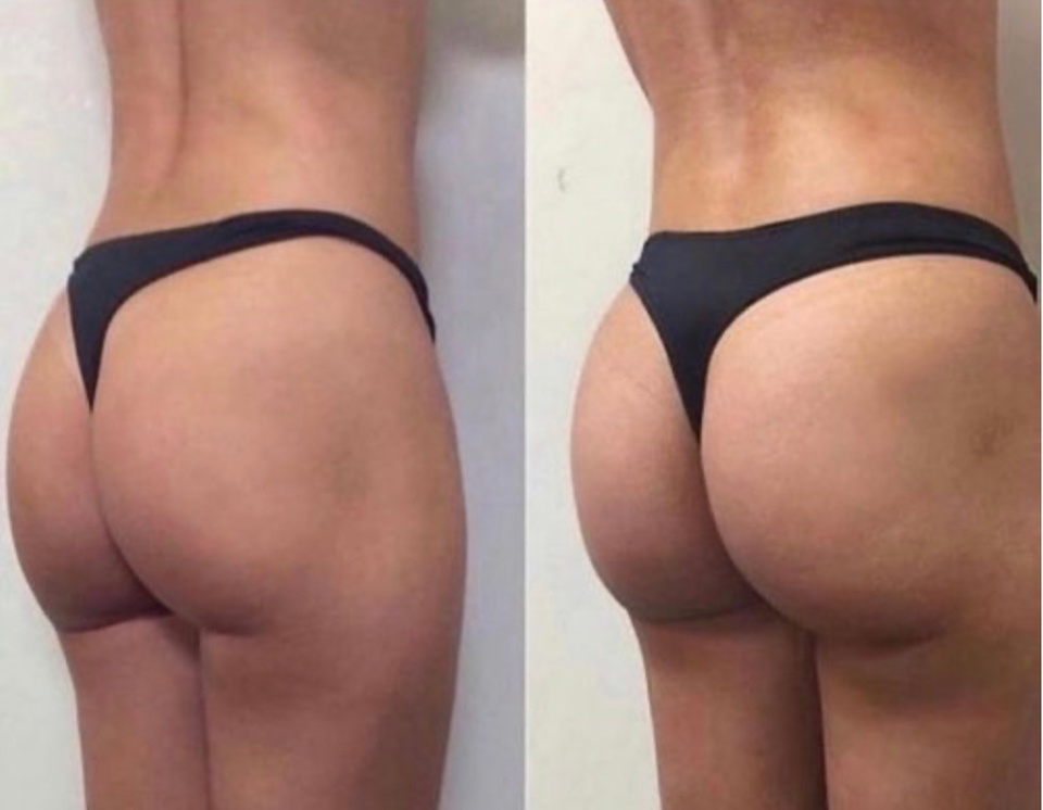 Up to 75% Off on Non-Surgical Butt Lift at Beauty and Bodied Aesthetics