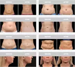 Discover Transformative Body Contouring with One or Two CoolSculpting at St. Jude Medical Center (Up To 77% Off)