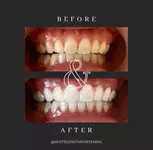 Up to 40% Off on Teeth Whitening at Seattle Teeth Whitening
