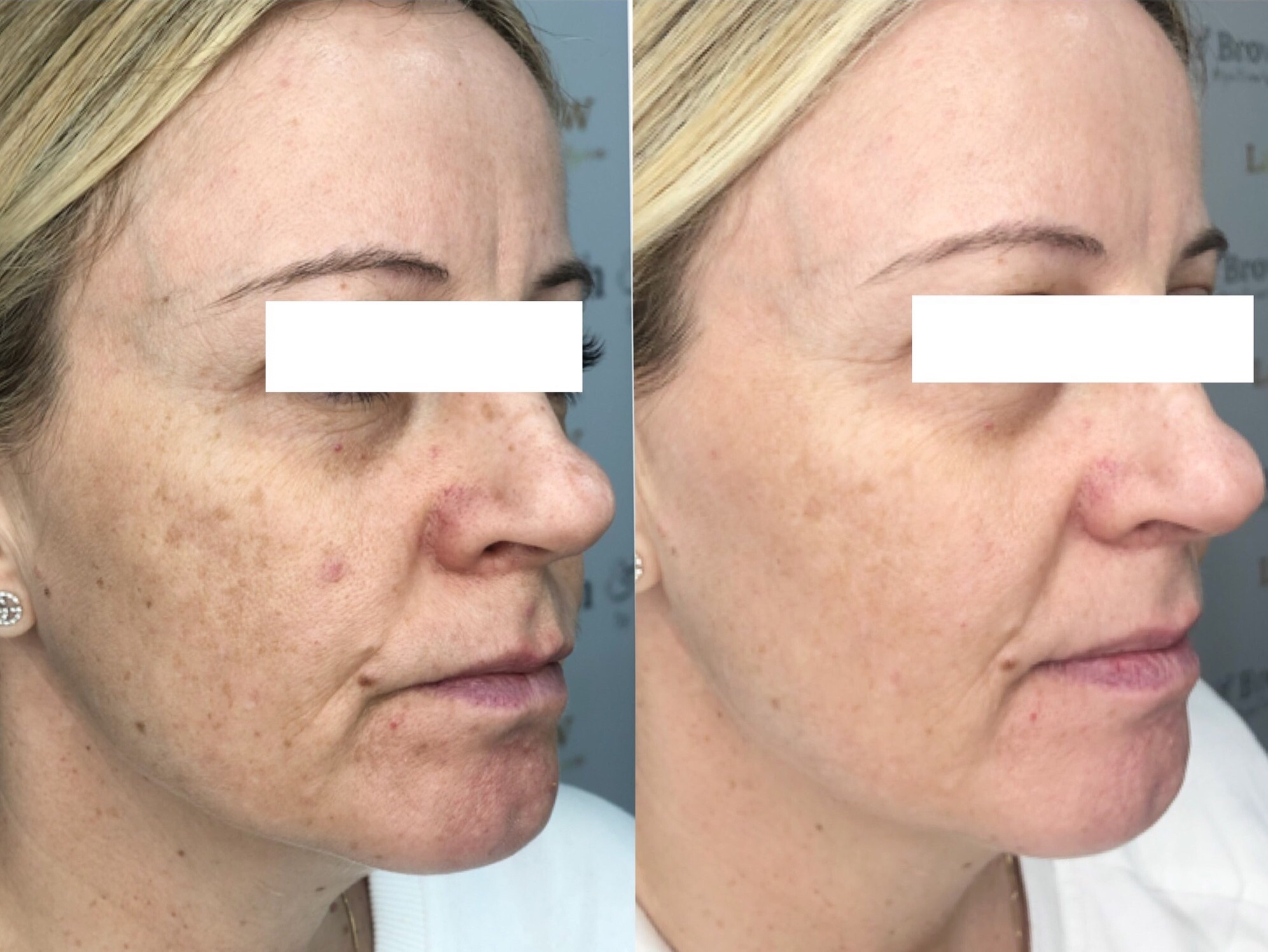 Revitalize with Laser Skin Resurfacing Options