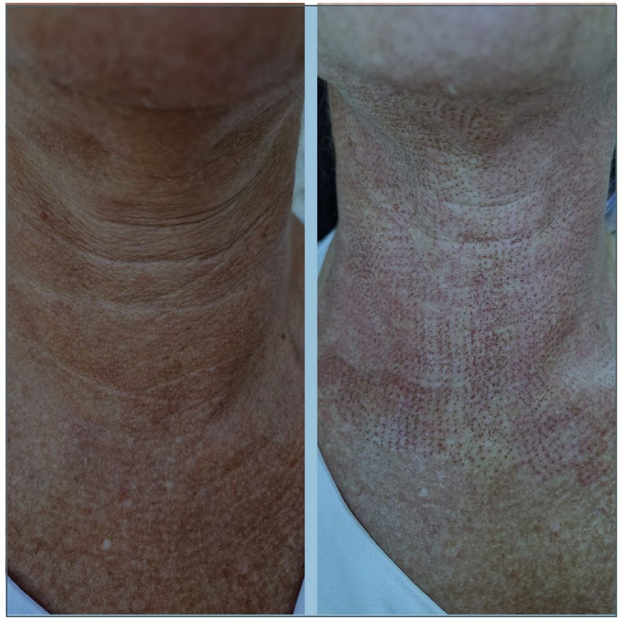 Fractional Plasma Resurfacing – Up to 55% Off