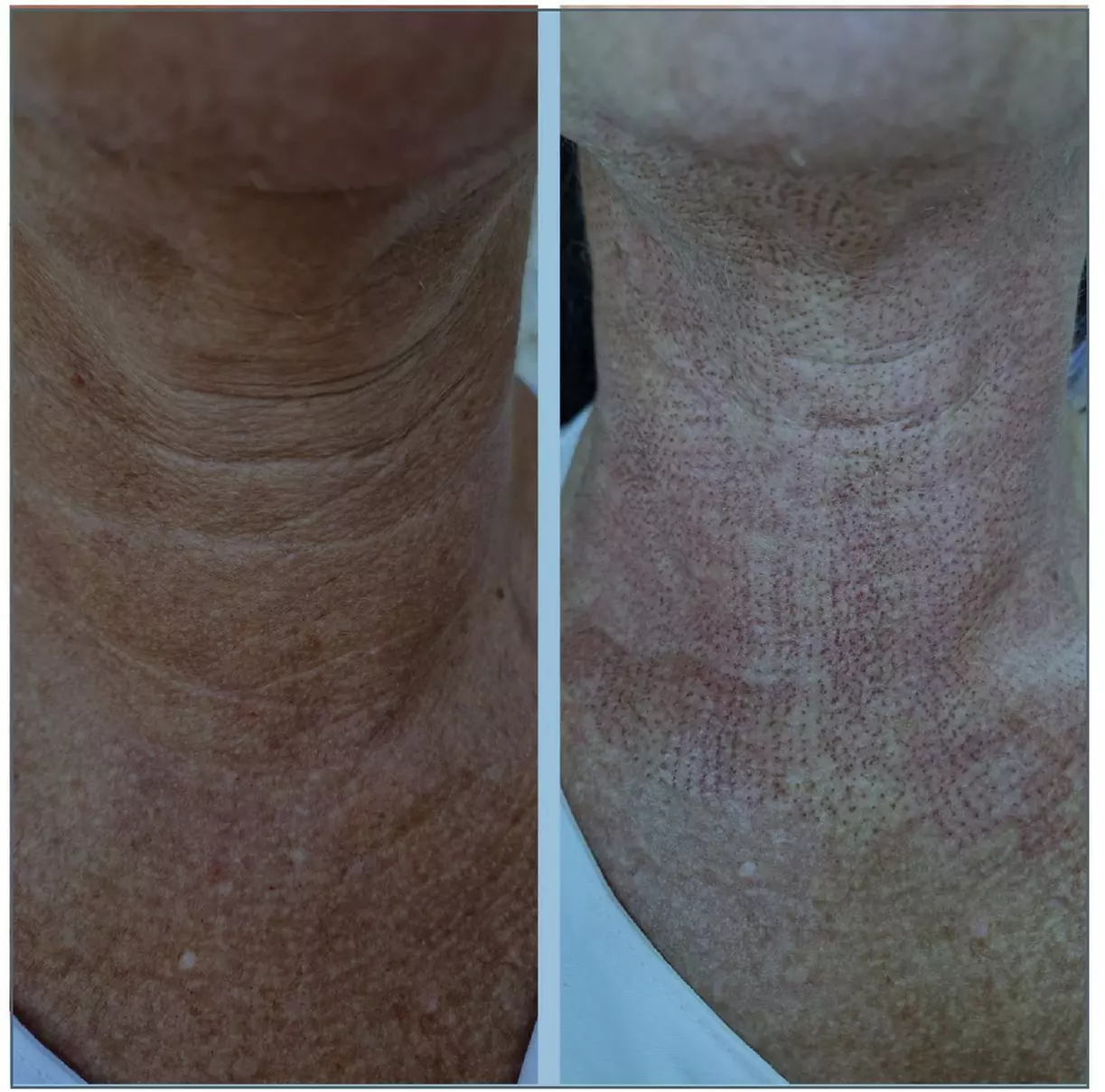 Up to 50% Off on Laser Skin Resurfacing - Branded at H.S. Medical Aesthetics & Wellness Center