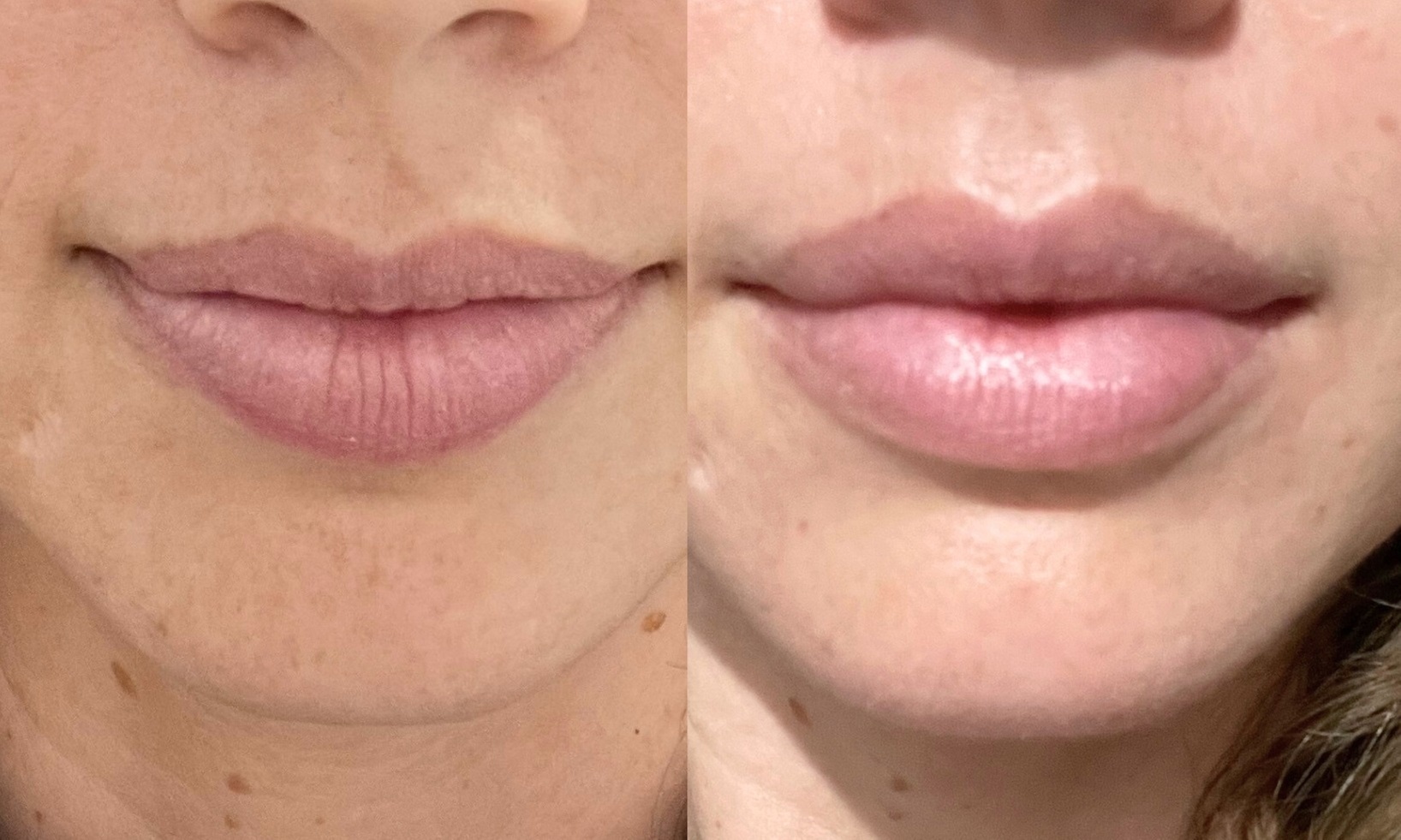 Up to 23% Off on Facelift - Non-Surgical at XOXO Beauty