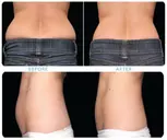 Discover Transformative Body Contouring with One or Two CoolSculpting at St. Jude Medical Center (Up To 77% Off)