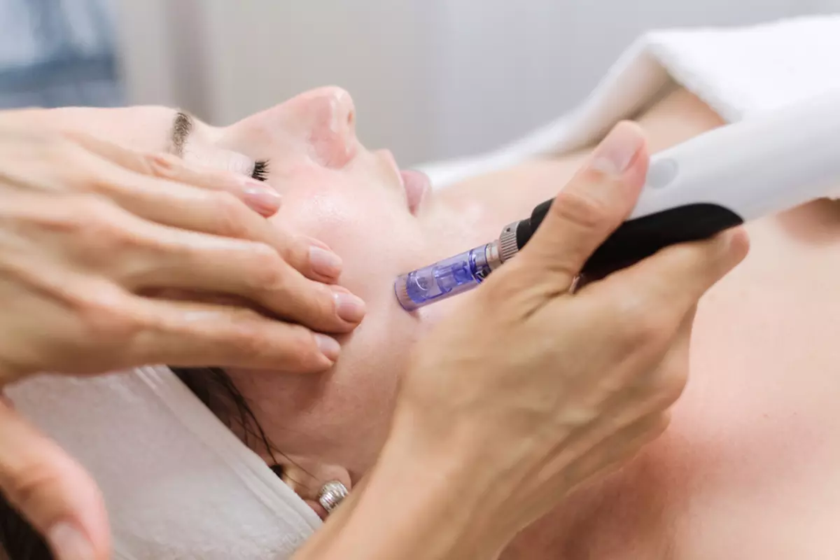 Microneedling with Laser Resurfacing for the Hands, Lower Eyes, Neck, or Full Face at Loma Laser (Up to 47% Off)
