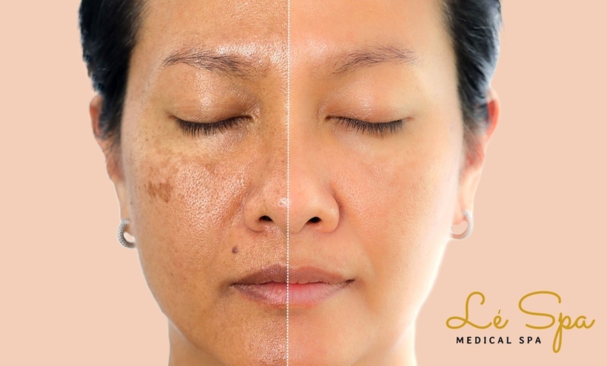 Glow Brighter: Up to 63% Off IPL Photo Facials