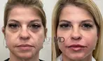 Reduce Fine Lines and Wrinkles with Botox Treatment