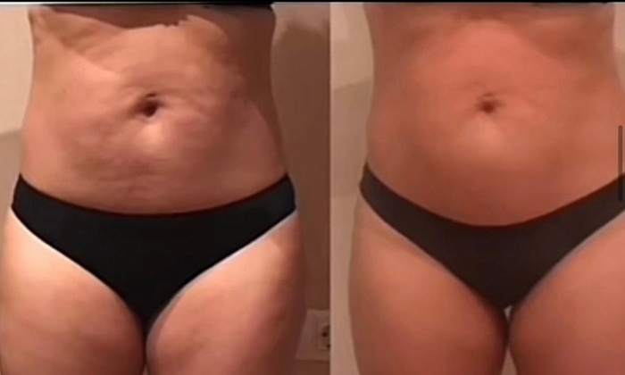 Up to 50% Off on Ultrasonic Fat Reduction at Beauty Molding Studio