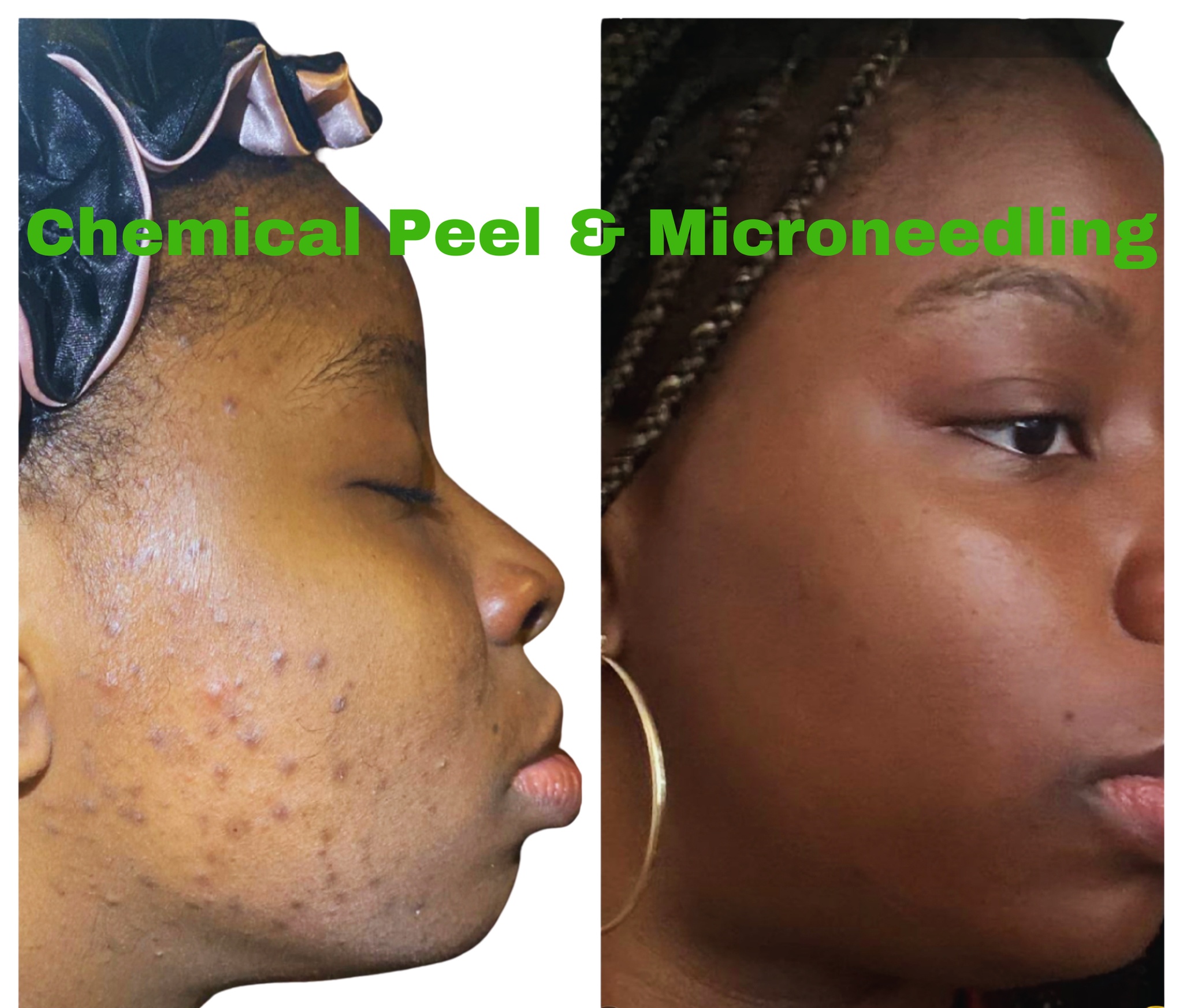 VI Peel: One Medical Grade Chemical Peel at Restorative Med Spa