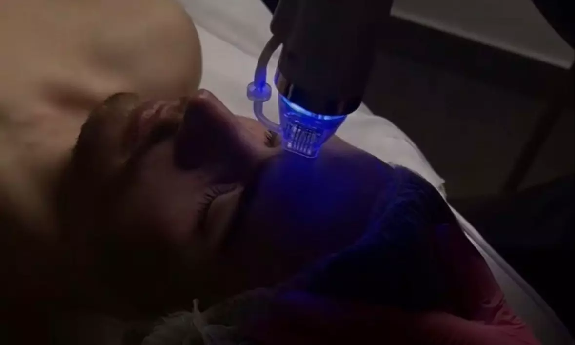 Radiofrekwencja mikroigłowa RF na twarz, szyję i dekolt