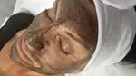 Pico Laser Carbon Peel with Complimentary Facial Cleaning