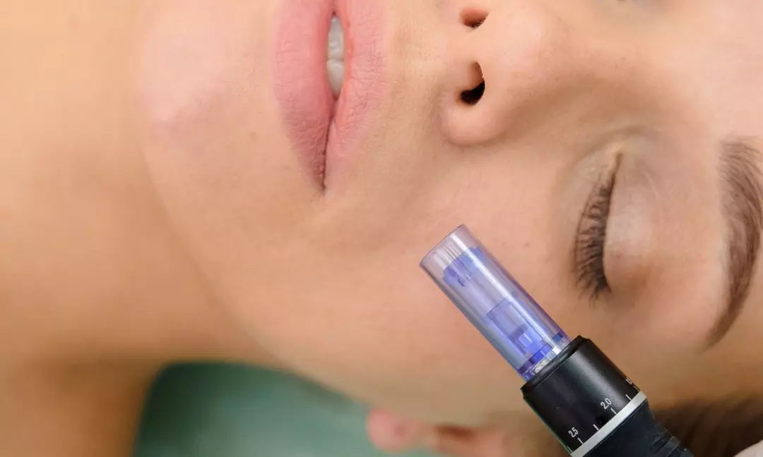 Transform your skin with one or three micro-needling treatments