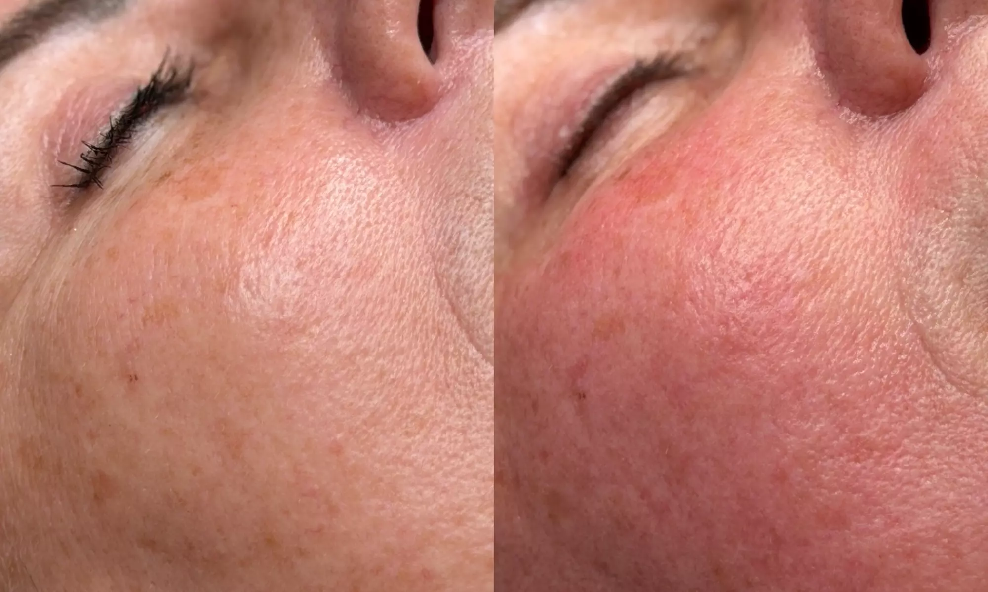 Radiofrekwencja mikroigłowa