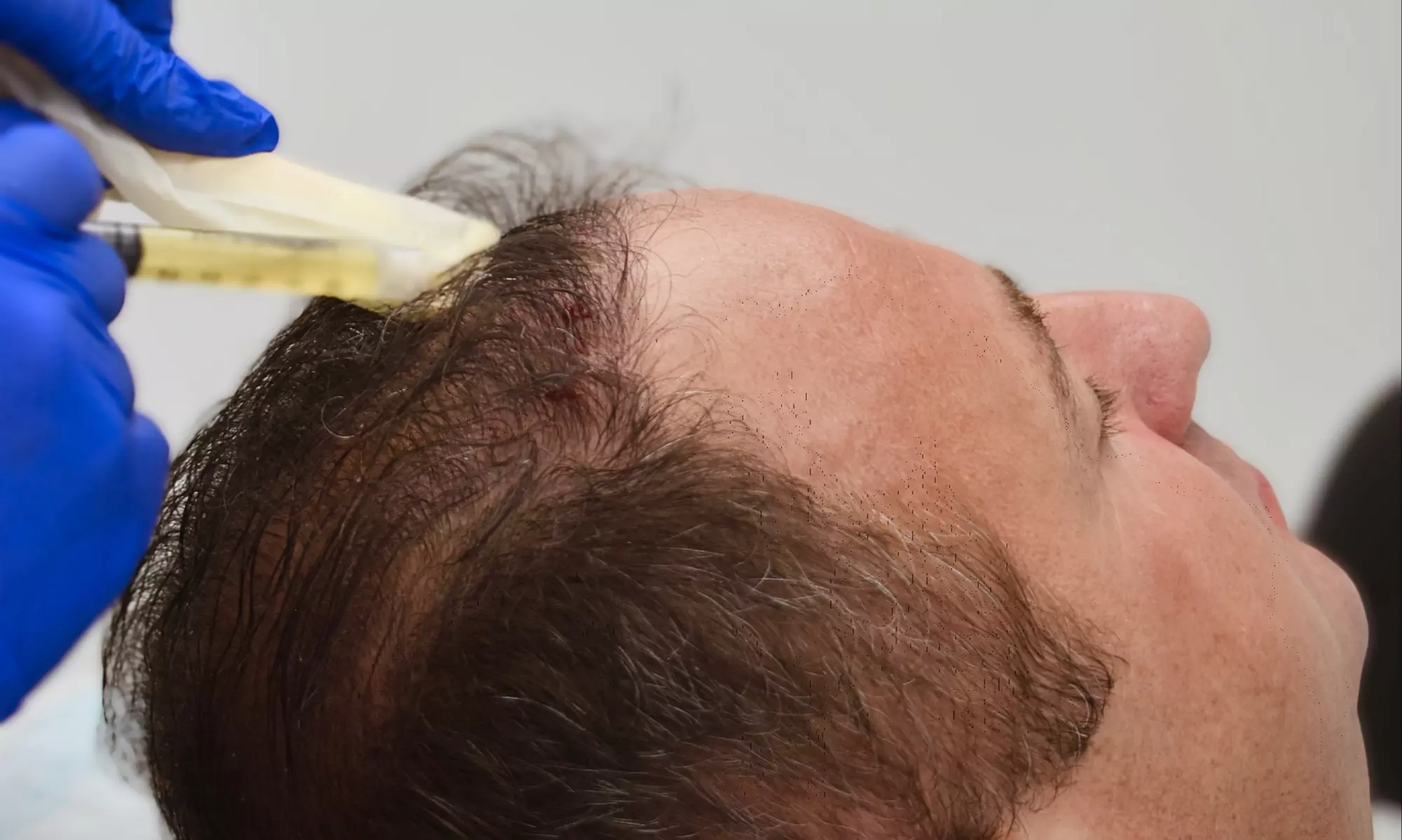 Transform Hair with One Plasma Session for Hair Restoration