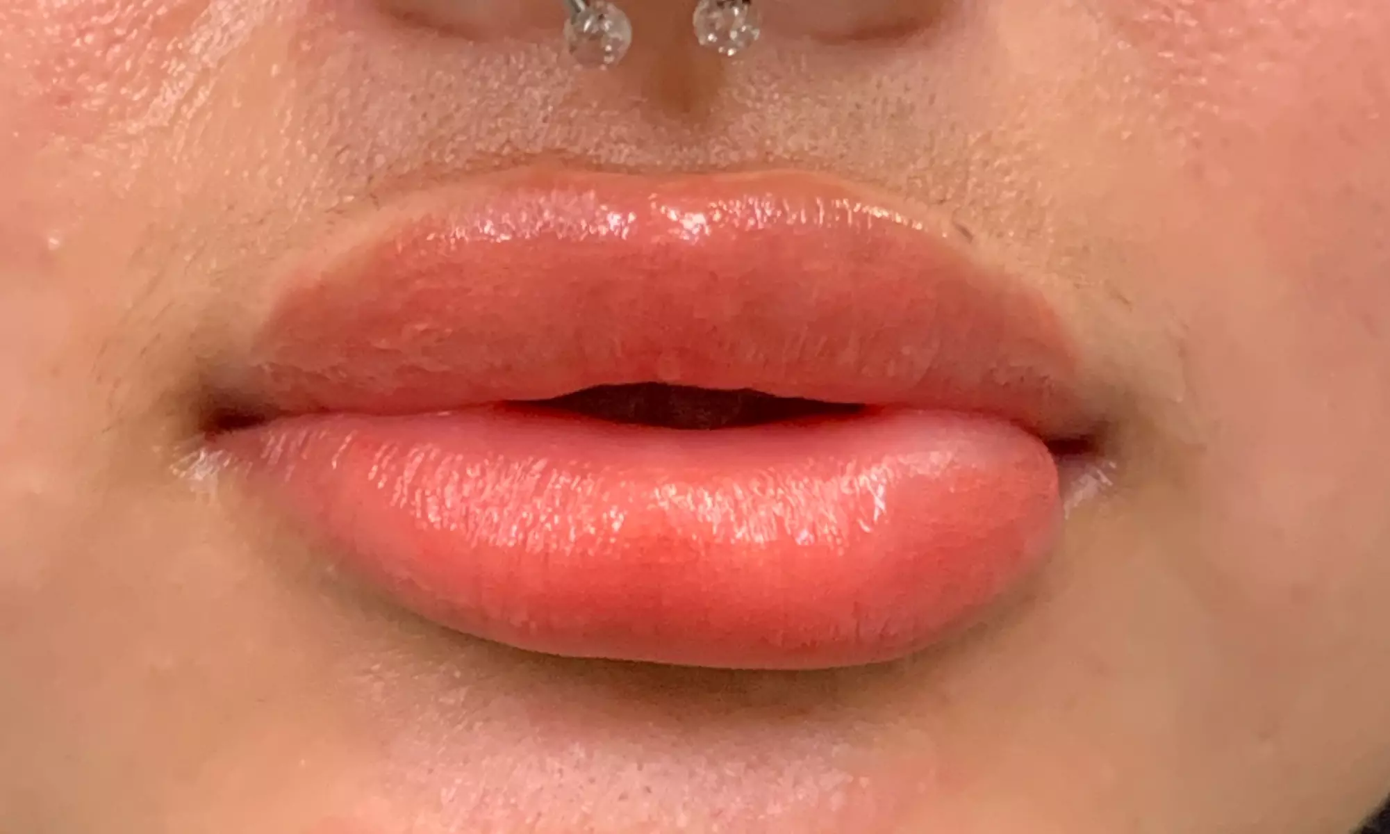 Enhance Natural Beauty with Lip Neutralization Treatment