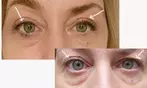 Plasma Fibroblast Eye, Jowl & Neck Lift Treatment
